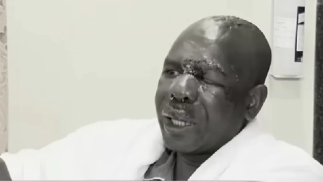 NMG Photojournalist Habil Kweyu Macheted in Face by Bodaboda Gang – Editors Guild Condemn Act
