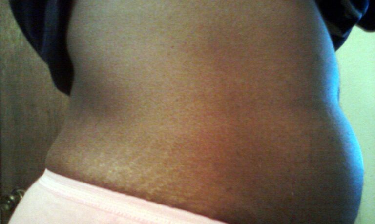 I Overcame Painful Fibroids After Years of Suffering and Finally Got My Strength Smile and Freedom Back